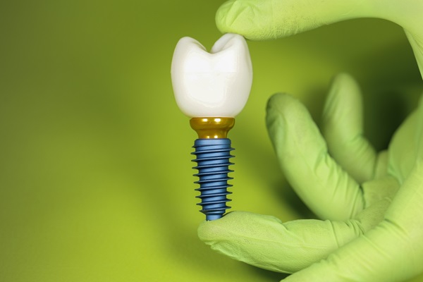 How Long Do Dental Implants Crowns Last?